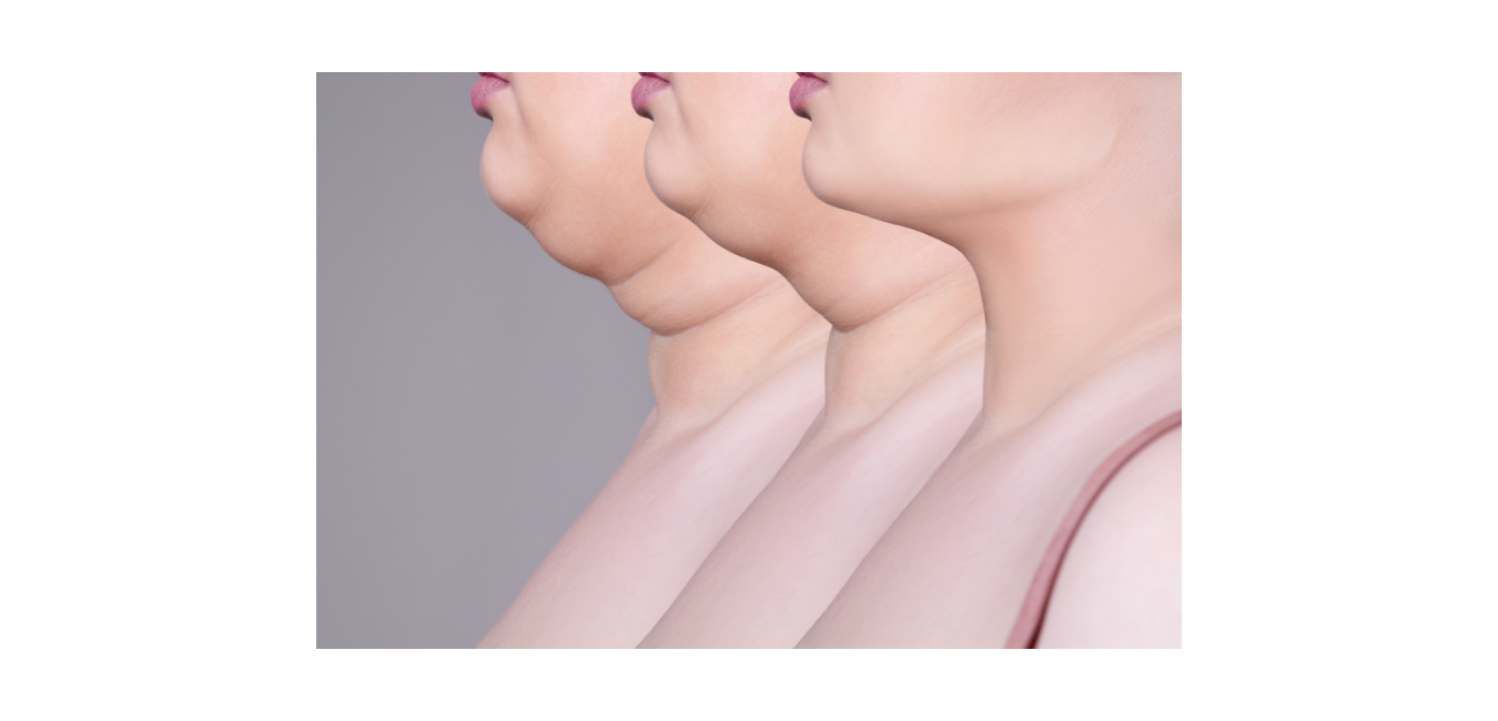 BeautiFill Liposuction for Double Chins